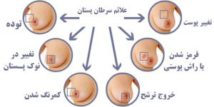 مشخصات توده سینه - علائم سرطان سینه در زنان - مرکز ماموگرافی و سونوگرافی دکتر صانعی