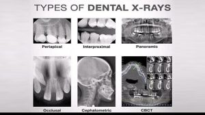 انواع تصویربرداری فک و دندان برای ایمپلنت – OPG، CBCT و پری‌آپیکال _ مرکز تصویربرداری دکتر صانعی